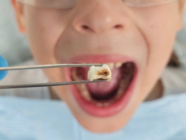 Best Emergency Tooth Extraction in East Palestine, OH
